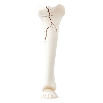 Broken Human Bone with Cracks on png