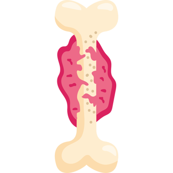 sarcoma bone cancer awareness png