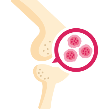 sarcoma bone cancer disease png