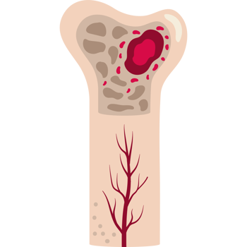 multiple myeloma disease awareness png