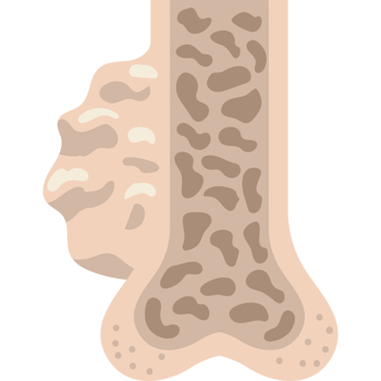 multiple myeloma cross section of bones png