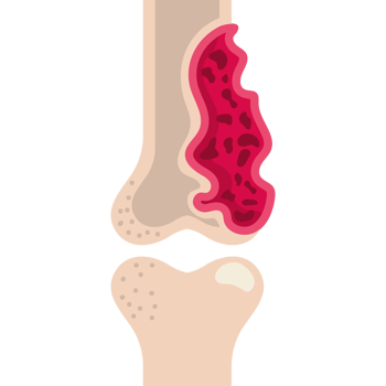 multiple myeloma bone marrow cancer png