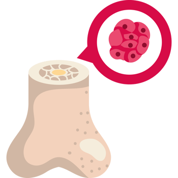 multiple myeloma bone awareness png