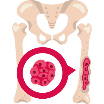 multiple myeloma is a cancer of the bone marrow png