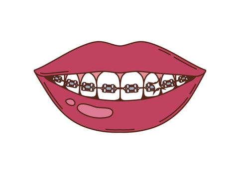 Cartoon groovy smiling lips with teeth with braces vector