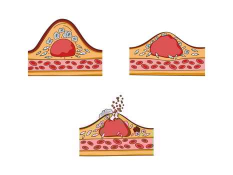 Cholesterol plaque structure and thrombus formation medical educational science illustration. Vascular anatomy vector