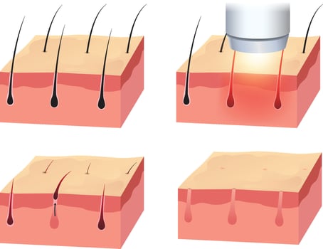 illustration of laser hair removal steps diagram vector