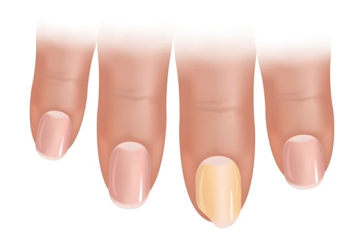 Nail diseases, onycholysis, fungal nail infections. Damaged yellow and green human nails. vector