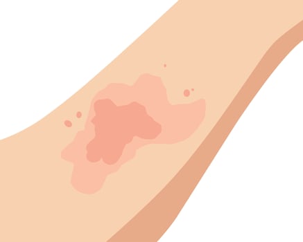 illustration of an allergic reaction on the skin, showing red rashes and irritation vector