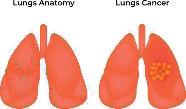 Healthy Lungs and Cancer Lungs Anatomy Science Design Illustration Diagram vector