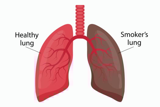 Illustration of healthy lung and smoker's lung. vector