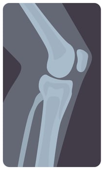 Lateral radiograph of human knee joint. Monochrome x-ray picture or radiographic monitor image of leg part, side view. Medical radiology of limb. Modern illustration in flat cartoon style vector