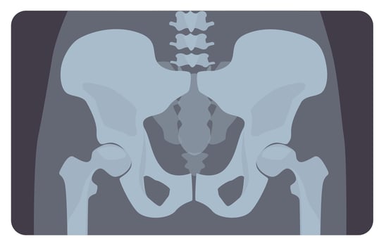 Anterior radiograph of human pelvis or hip bone with lumbar part. X-ray picture or image of human skeletal system, front view. Medical disease detection. illustration in flat cartoon style vector