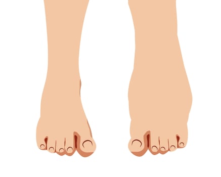 illustration of swollen human feet edema viewed from above. Ideal for medical, healthcare, and anatomy-related designs. Isolated on a light background vector