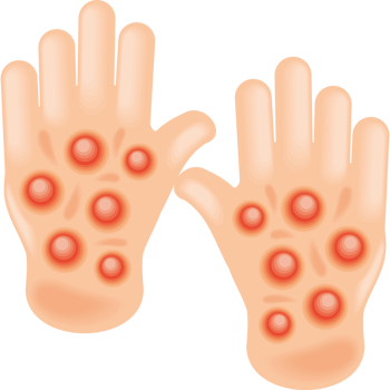 hands with monkeypox png