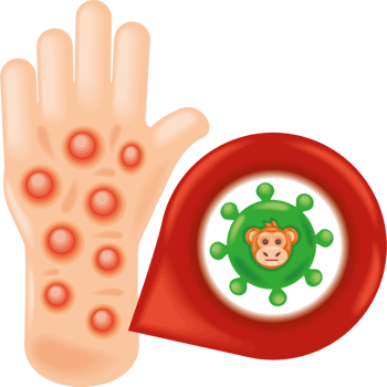 human hand with monkeypox skin infection png