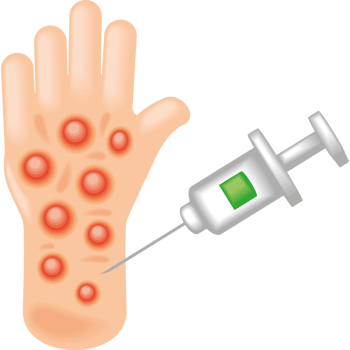vaccination against monkeypox virus png