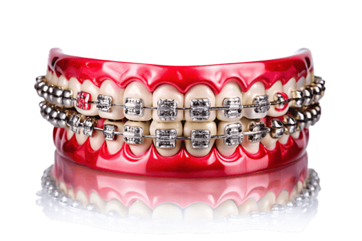 Closeup of a Dental Model with Metal Braces Showing Orthodontic Treatment png