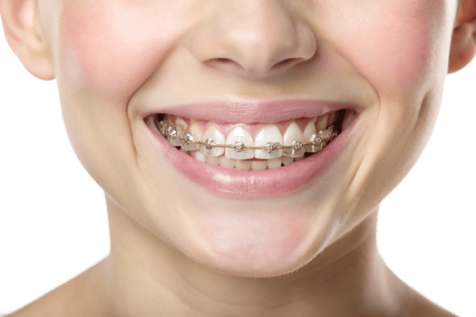 Closeup of a Young Woman Smiling with Clear Braces on her Teeth png