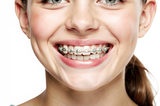Closeup of a Young Woman Smiling and Showing Her Teeth with Clear Braces and Green Accents png