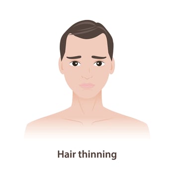 Hair thinning is hair problems for men illustration. The man with thin hair, that can from genetics, hormonal changes, medical conditions, stress, poor nutrition and can be temporary or permanent. vector