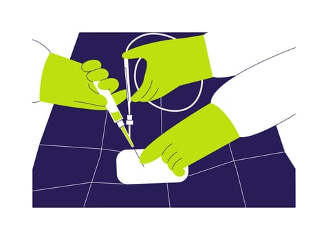 Endovascular surgery abstract concept illustration. vector