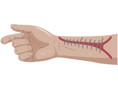 hand injury surgical stitches detailed isolated illustration on white background vector