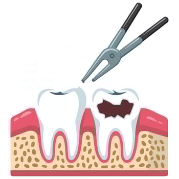 dental forceps extracting human tooth isolated illustration on white background vector