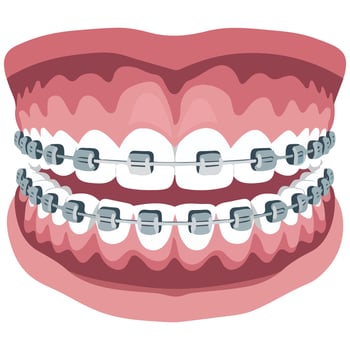 smile teeth alignment whitening process isolated illustration on white background vector