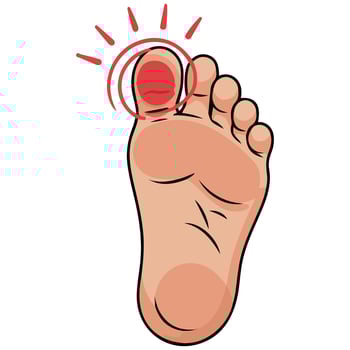 Swollen stubbed toe injury isolated illustration on white background vector