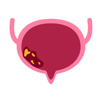 Bladder disease illustration vector