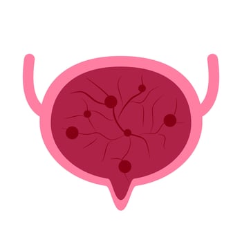 Inflammation Bladder illustration vector