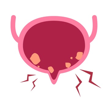 Bladder stones illustration vector