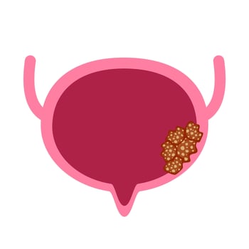 Cystitis bladder illustration vector