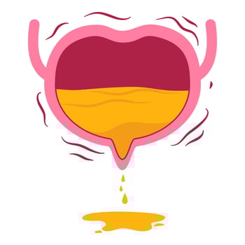 Urinary incontinence illustration vector