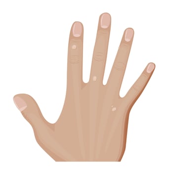 Hand showing common warts on skin vector