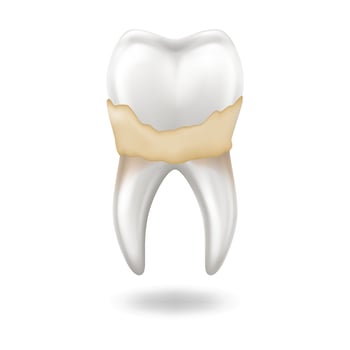 Realistic illustration of human tooth with yellowish plaque or tartar buildup showing dental health concept on white background. Useful for dental care education or medical articles. vector