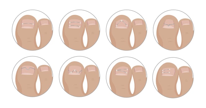 Podiatrist applying different kinds of metallic threads for ingrown toenail correction vector