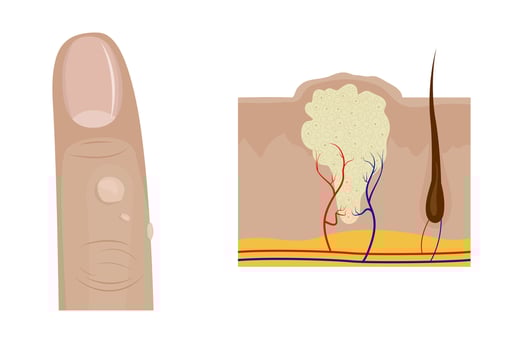 Common warts growing on finger and cross section of wart anatomy vector