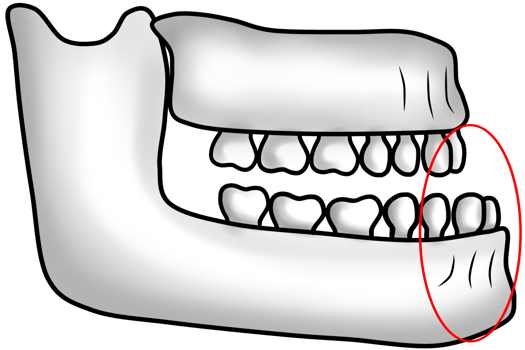 Abnormal jawbone structure with protruding lower jaw causing an underbite png