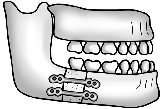 Post-surgical lower jawbone structure after correction of a protruding chin png