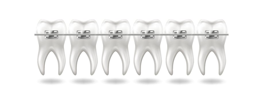 Illustration showing white teeth with metal braces for orthodontic treatment on white background. Ideal for dental care and orthodontics promotions demonstrating teeth alignment with copy space. vector