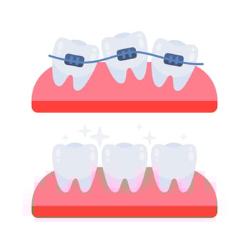 Teeth straightening with braces showing before and after stages vector