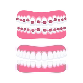 Orthodontic treatment showing teeth with and without braces vector