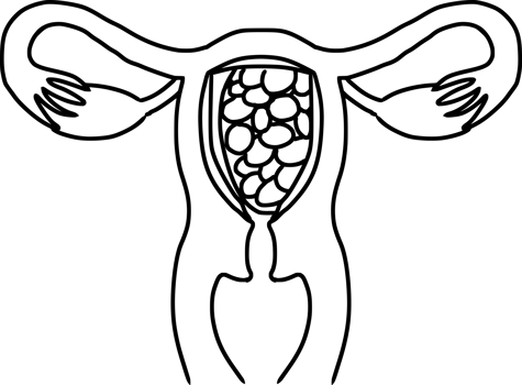 Hydatidiform mole diagram line illustration with transparent background png