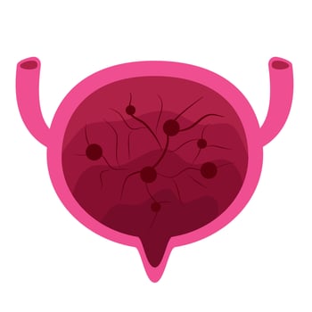 Cystitis bladder illustration. Inflammation Bladder vector