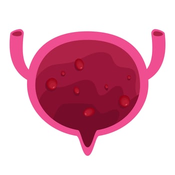Bladder polyps illustration. Bladder disease vector