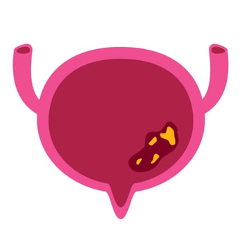 Bladder cancer illustration. Bladder disease vector