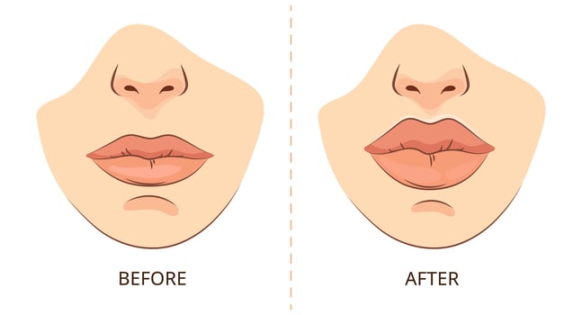 Lip Augmentation Before and After .Female lips before and after cosmetic augmentation beauty clinic presentations aesthetic treatment infographics medical brochures, cosmetic surgery ads vector