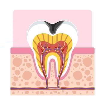 Tooth decay cross section showing cavity damage to enamel, dentin, and pulp for dental education and medical vector